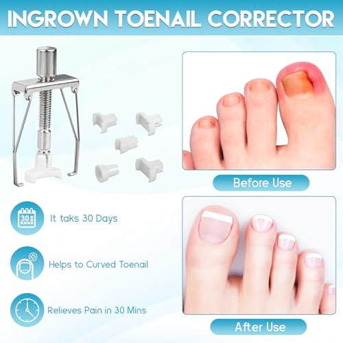 Ingrown Toenail Removal Kit, Professional Ingrown Toenail Tool Kit Includes Ingrown Toenail Corrector Drops, Corrector Patch, Toenail Clipper, Nail File Lifter Pedicure Tools