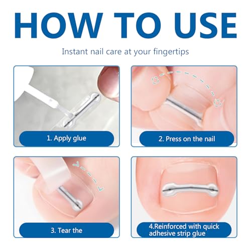 Ingrown Toenail Treatment, Titanium Alloy Ingrown Toenail Removal Kit for Repair Curved Nail, Ingrown Toenail Corrector Tool for Home Use