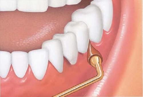 GUM Stimulator 1 Each (Pack of 4)