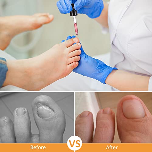 Ingrown Toenail Treatment - Ingrown Toenail Pain Reliever and Softener Kit for Easy Trimming with Silicone Gel Toe Caps