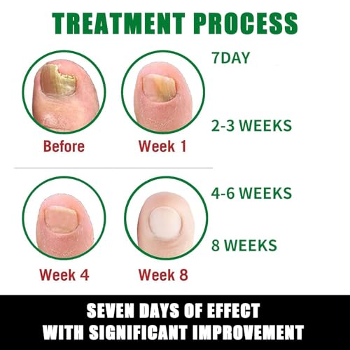 7 days Nail Treatment, Ginger Nail Treatment, 7days nail treatment, Multi-Purpose Nail Repair, Ginger Nail Serum Strengthener Oil Serum Ginger Nail Growth Oil