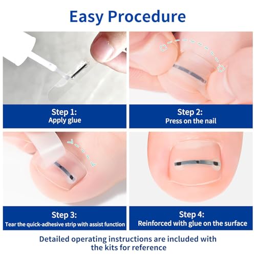 Ingrown Toenail Treatment, 10 packs Titanium Alloy Ingrown Toenail Corrector for all size foot, Ingrown Toenail Removal Kit for Curved Nail Repair, at Home Nail Kit Tools-Blue2