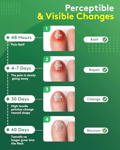 Ingrown Toenail Treatment Kit - Titanium Alloy Nail Corrector Tools, Quick Relief & Long-term Correction Patch for Ingrown Nails, Solution for Curved Toenail Repair & Removal (0.51/0.59/0.67/0.79in)