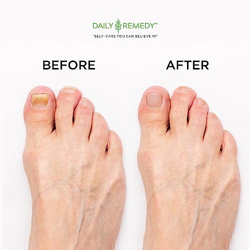 DAILY REMEDY EXTRA STRENGTH Tea Tree Oil Foot Soak w/ Epsom Salt Made in USA Toenails，Athlete's Foot，Itchy Feet，Stubborn Smelly Foot Odor，Pedicure Calluses & Soothes Sore Tired Achy Feet 16 oz，Black