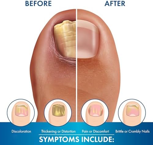 Brite Now Nail Treatment, Restores The Appearance Of Damaged & Discolored Nails, Peel-Away Technology, Brightening & Smoothing Nail Repair, 0.5 Ounce