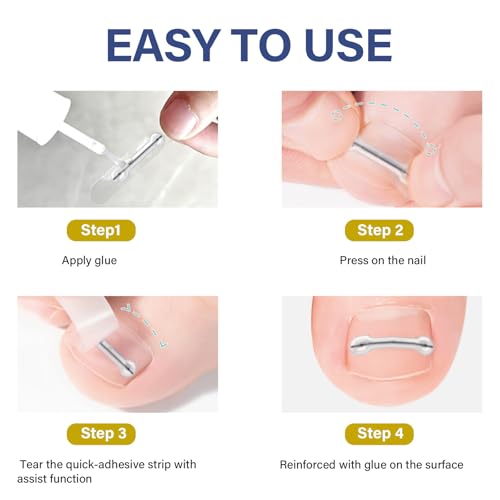 Ingrown Toenail Treatment, 10 packs Titanium Alloy Ingrown Toenail Corrector for All Size Curve Correct Ingrown Toenail, Ingrown Toenail Removal Kit for Straightener of Big Toe