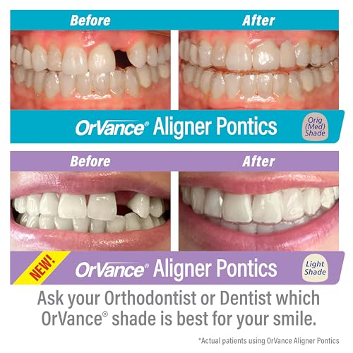 Aligner Pontics - Original (Medium) Shade (16 Count) | Temporary Tooth Replacement for Invisalign, Aligner Trays and Clear Retainers During Orthodontic Treatment