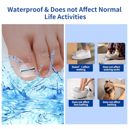Ingrown Toenail Treatment, 10 packs Titanium Alloy Ingrown Toenail Corrector for all size foot, Ingrown Toenail Removal Kit for Curved Nail Repair, at Home Nail Kit Tools-Blue2