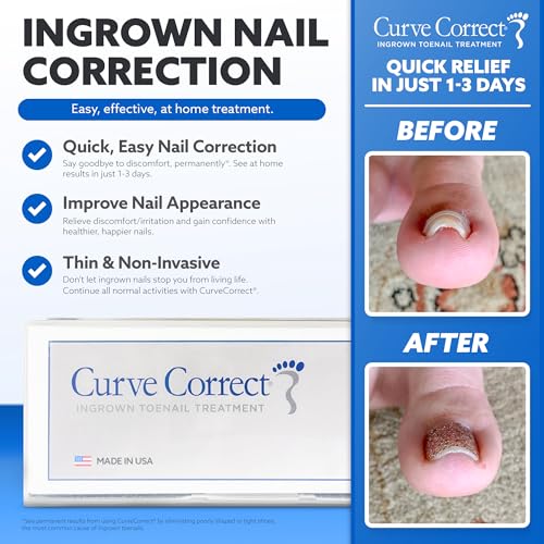 CurveCorrect® Ingrown Toenail Treatment Kit - Ingrown Toenail Corrector Kit with 10 Braces - at Home Ingrown Toenail Correction - Big Toe Ingrown Nail Treatment