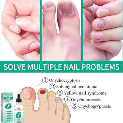 Kerassentials Toenail Oil, Kerassentials Nails colourless (3PCS)