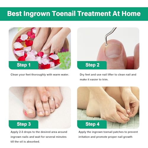 Ingrown Toenail Treatment - Ingrown Toenail Softener Drops,Toenail Lifter,Nail Patches,Best Ingrown Toenail Kit at Home for Easy Trim Thick Toe Nails Cleaner Tool Kit