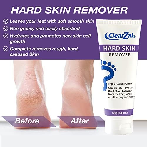 ClearZal Foot Cream For Hard Skin, Helps Calluses and Corn Removal While Leaving Soft Smooth Skin, Hydrating and Conditioning Triple Action Formula With Aloe Vera, 3.4 Ounce Tube
