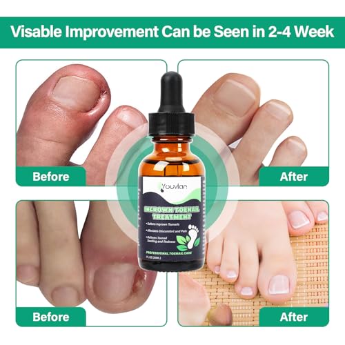 Ingrown Toenail Treatment - Ingrown Toenail Softener Drops,Toenail Lifter,Nail Patches,Best Ingrown Toenail Kit at Home for Easy Trim Thick Toe Nails Cleaner Tool Kit