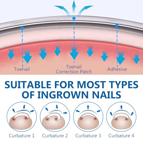 Ingrown Toenail Treatment, Titanium Alloy Ingrown Toenail Removal Kit for Repair Curved Nail, Ingrown Toenail Corrector Tool for Home Use