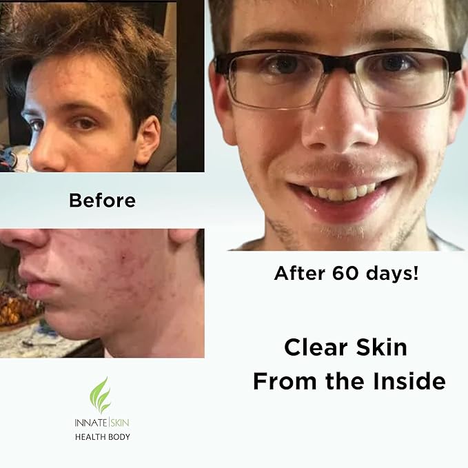 Clear Skin Acne Vitamin System | 20 Antioxidants, Botanicals & Minerals | 60 Count Pack of 2